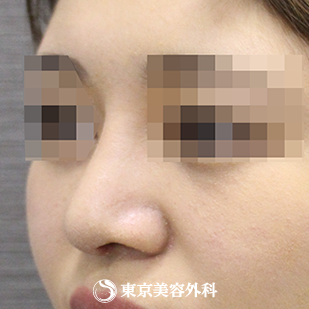 【鼻尖形成（軟骨移植）・隆鼻術（シリコンプロテーゼ）｜si4002】の症例写真 術後1ヵ月【4枚目】