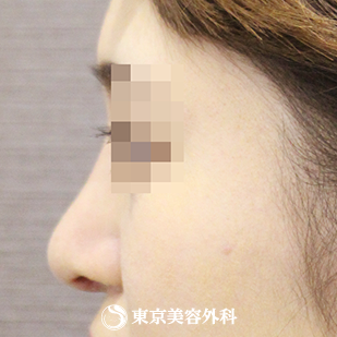 【鼻尖形成（軟骨移植）・隆鼻術（シリコンプロテーゼ）｜si4002】の症例写真 術後1ヵ月【6枚目】