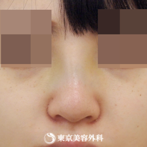 【隆鼻術（オーダーメードプロテーゼ）、小鼻縮小(外側切開）、ケーブル法｜ak3748_】の症例
