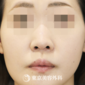 鼻痩せの方法は 鼻の脂肪をすっきりさせて団子鼻を解消しよう 美容整形は東京美容外科