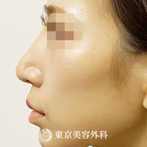 【 鼻尖形成（耳介軟骨、鼻尖縮小、人中短縮、エラボト)｜ak4605】の症例