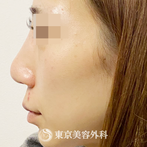 【 鼻尖形成（耳介軟骨、鼻尖縮小、人中短縮、エラボト)｜ak4605】の症例