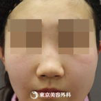 【鼻中隔延長（肋軟骨）、隆鼻術（オーダーメードプロテーゼ）、鼻骨骨切り、鼻翼縮小｜as4616】の症例