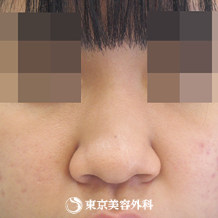鼻プロテ 鼻中隔延長 鼻尖形成 鼻骨切 Si7219 の症例写真 美容整形は東京美容外科