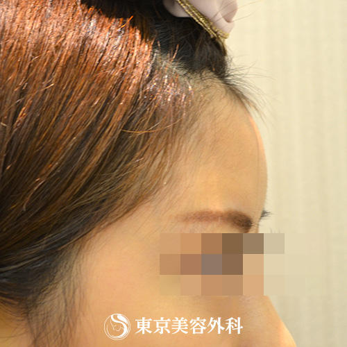 額ヒアルロン酸 Gz4297 額ヒアルロン酸注入で立体的な顔立ちに 美容整形は東京美容外科