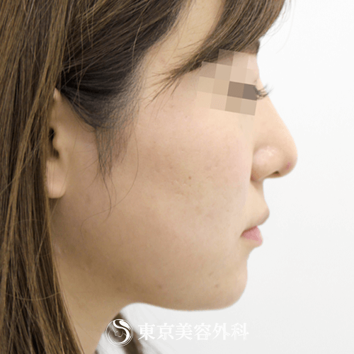 鼻ヒアルロン酸 顎ヒアルロン酸 Si1242 たった5分でバランスのとれた綺麗な横顔に 美容整形は東京美容外科