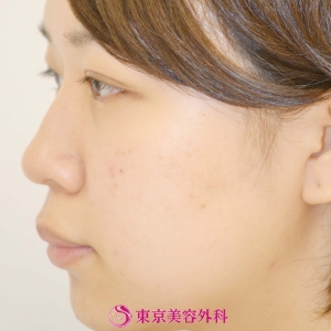 オーダープロテーゼ 鼻尖形成 自家軟骨 ｌｇｚ 整った鼻でバランスの良い顔に 美容整形は東京美容外科
