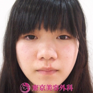小鼻縮小 鼻が変わるだけで顔全体の雰囲気が変わる 美容整形は東京美容外科