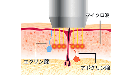 すそわきがの治療 ミラドライ 美容整形は東京美容外科