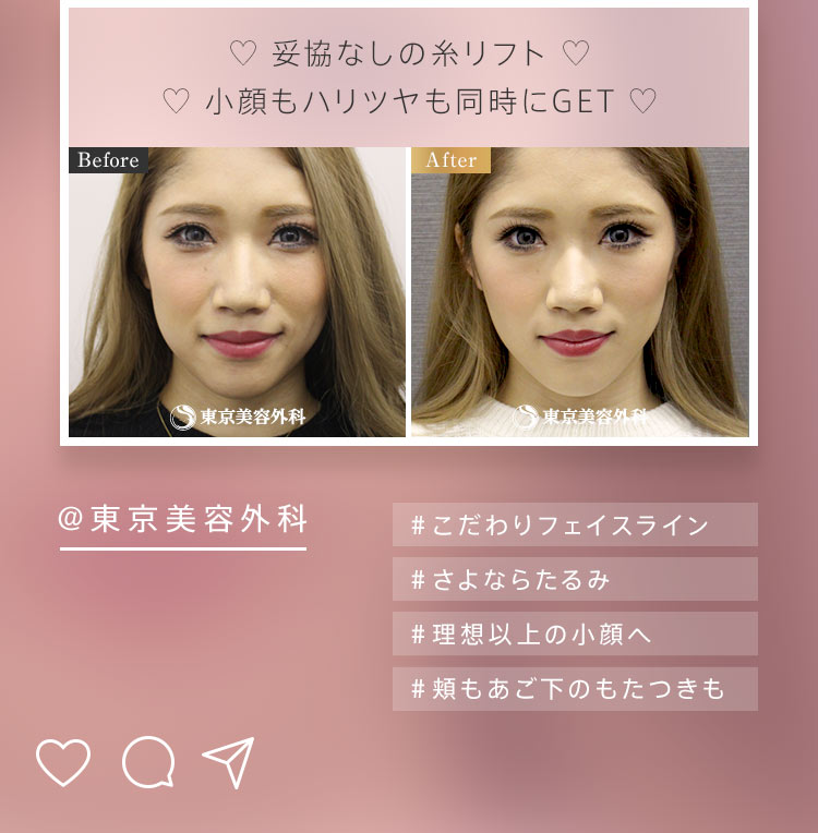 @東京美容外科 #こだわりフェイスライン #さよならたるみ #理想以上の小顔へ #頬もあご下のもたつきも