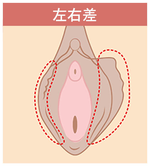 左右差