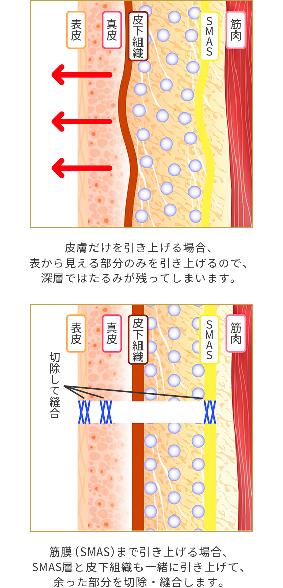 フェイスリフト 美容整形は東京美容外科