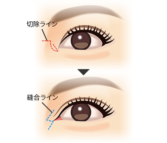 目頭切開による二重まぶた整形 美容整形は東京美容外科