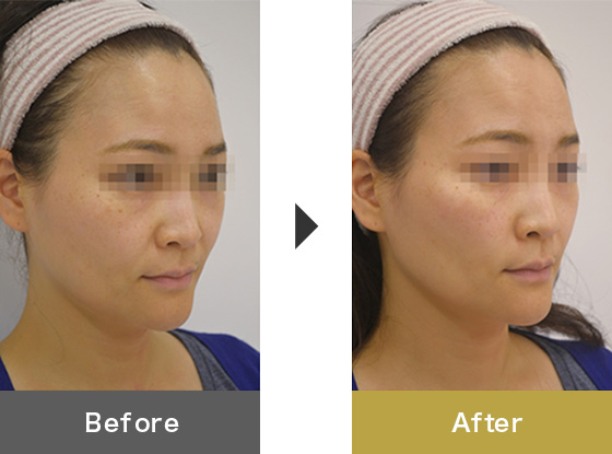 ヒアルロン酸注入による頬のリフトアップ 美容整形は東京美容外科