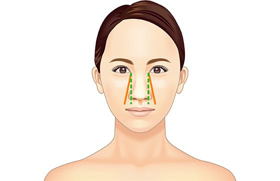 小鼻 鼻翼縮小 切開 美容整形は東京美容外科