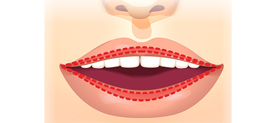 口唇縮小 美容整形は東京美容外科