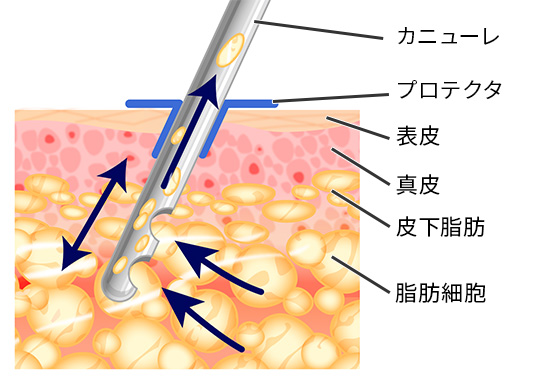 脂肪吸引 二の腕 ふくらはぎなど 美容整形は東京美容外科